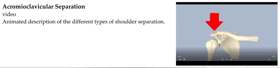 Acromioclavicular Separation video Animated description of the different types of shoulder separation.
