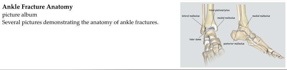 Ankle Fracture Anatomy picture album Several pictures demonstrating the anatomy of ankle fractures.