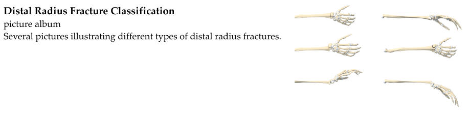 Distal Radius Fracture Classification picture album Several pictures illustrating different types of distal radius fractures.
