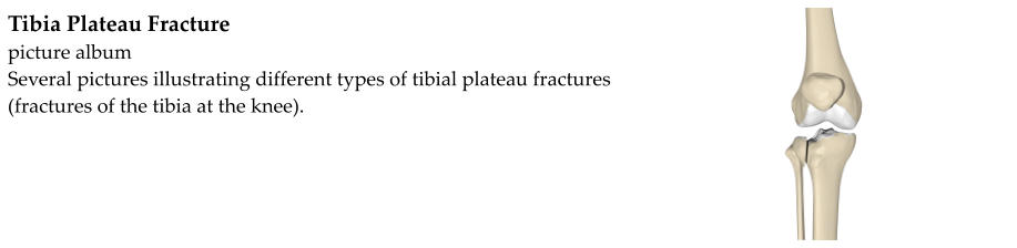 Tibia Plateau Fracture picture album Several pictures illustrating different types of tibial plateau fractures (fractures of the tibia at the knee).